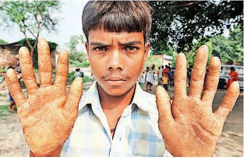 Boy in Ballia shows the skin infection on his hands caused by arsenic poisoning