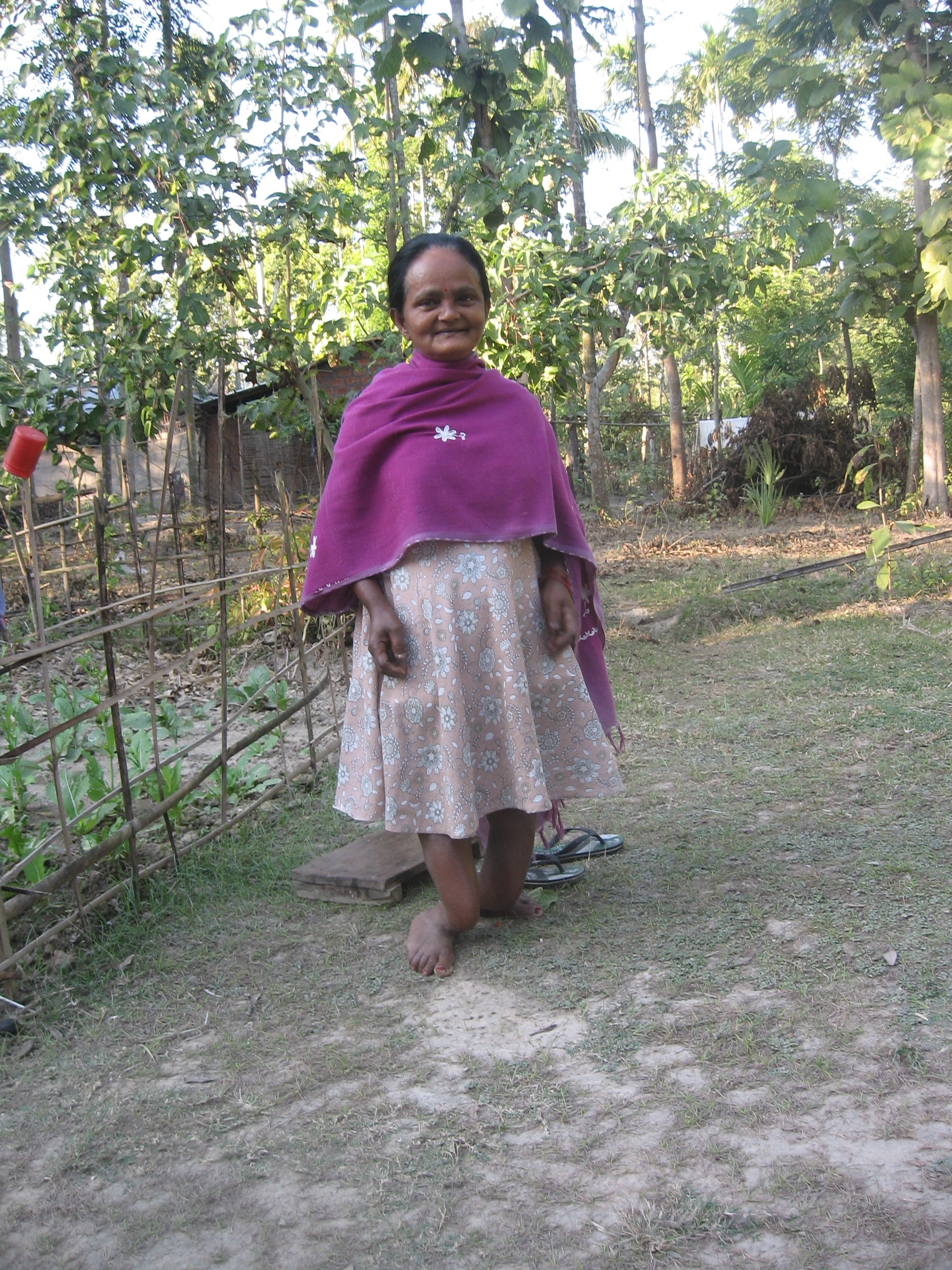 Sadhani Kalita of Tapatjuri village suffers from dental and skeletal fluorosis.