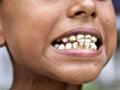 Stains, irregularities, and pits are common manifestations of dental fluorosis. (Image: Sehgal Foundation)