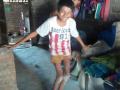 Dilip in Bankpura village, Dhar, MP suffers from skeletal fluorosis (Source: Dalpat & Heena)