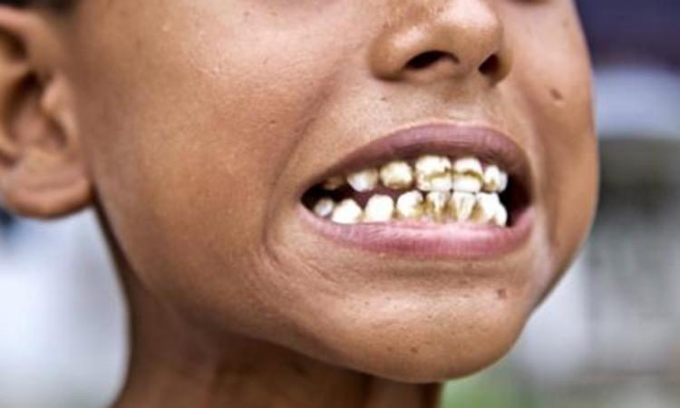 Stains, irregularities, and pits are common manifestations of dental fluorosis. (Image: Sehgal Foundation)